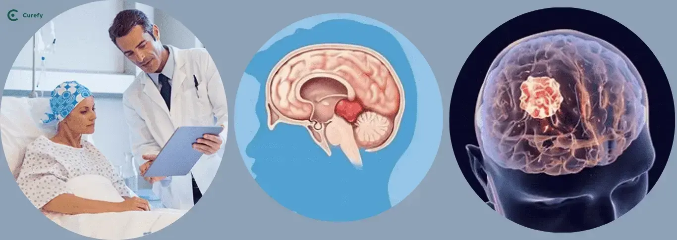 Brain Tumor Treatment - Curefy